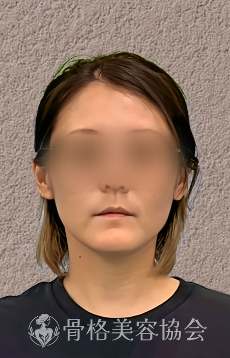 骨格美容とは 3ヶ月での変化 イメージ画像2